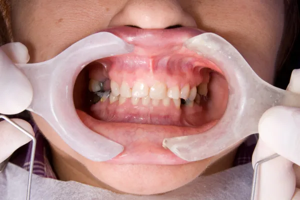 Bone Grafting & Sinus Lifts